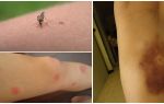 Warum bleiben Blutergüsse nach Mückenstichen?