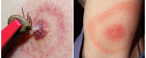 Was ist Lyme-Borreliose, seine Symptome, Behandlung und Foto