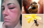 Was ist, wenn eine Biene in das Auge gebissen wird und es angeschwollen ist?
